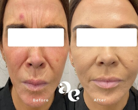 Anti-Wrinkle Forehead Treatment Anti Wrinkle treatment