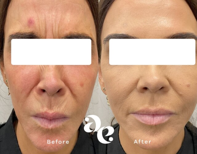 Anti-Wrinkle Forehead Treatment Anti Wrinkle treatment