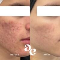 Acne scar treatment comparison