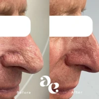 CO2 Laser for Rhinophyma treatment Side-by-side close-up comparison of a nose before and after cosmetic treatment, showing smoother skin texture and refined contour on the after image to the right.