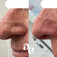 CO2 Laser for Rhinophyma Treatment Close-up side-by-side comparison of nose skin before and after treatment, showing smoother texture and reduced redness (left: Before, right: After).