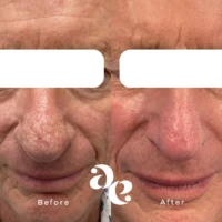 CO2 Laser for Rhinophyma Treatment Side-by-side before and after close-up of an older man's face, showing smoother skin and fewer wrinkles on the right after treatment.