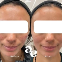 Side-by-side portrait of a woman with clearer skin on the right and more acne on the left, eyes covered for privacy, showing before and after skin improvement.