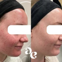 IPL Laser Side-by-side before and after photos showing reduced facial redness and acne after treatment (left before, right after).