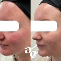 IPL Laser Side-by-side before-and-after photos of a woman's cheek and jawline showing reduced redness and acne scars after treatment (Before on left, After on right).