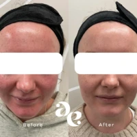 IPL Laser Before and after comparison of facial redness reduction after skincare treatment; left shows red, irritated skin, right shows calmer, more even tone.