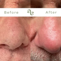 Close-up side-by-side of a nose showing skin texture before and after treatment, highlighting reduced pore size and smoother skin on the right.