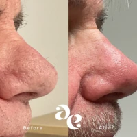 Left panel shows a nose before treatment with rough skin texture; right panel shows after treatment with smoother skin and refined nasal shape.