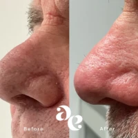 Split-screen close-up of a nose showing skin changes: left side before with sun-damaged, freckled skin; right side after with smoother, redder skin.
