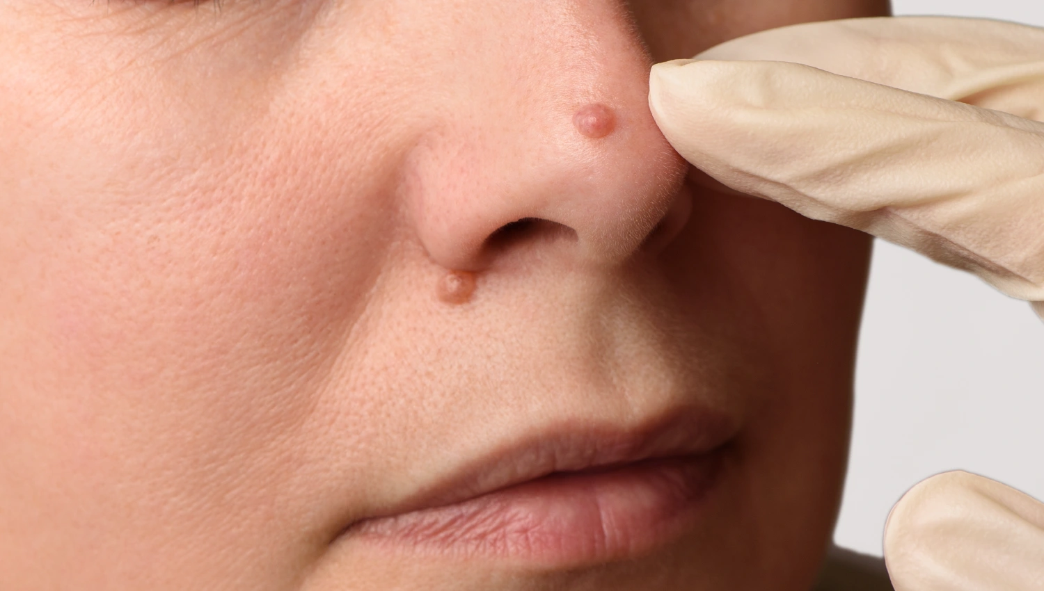 Laser to Prevent Skin Cancer