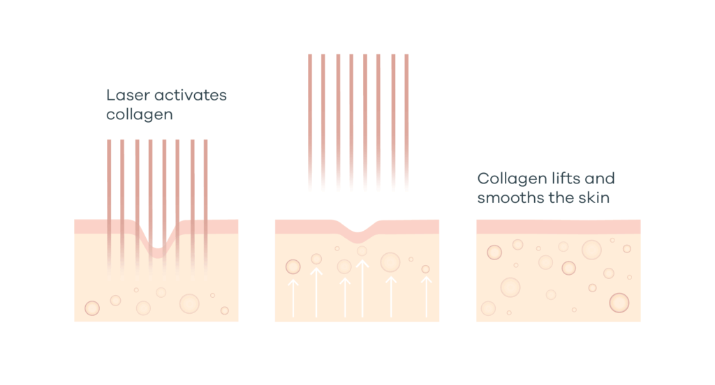 coolpeel-mechanism - Anue