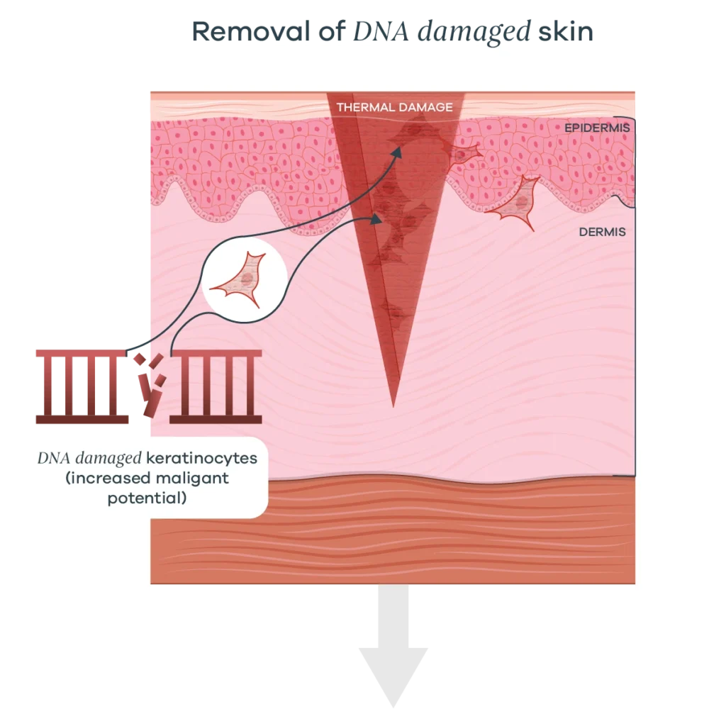 Cross-section of skin showing a thermal injury penetrating the epidermis and dermis, with DNA-damaged keratinocytes highlighted and labels for epidermis and dermis.