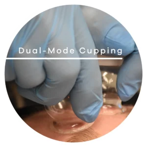 Close-up of a gloved hand applying a glass cupping cup to the skin for therapy, with 'Dual-Mode Cupping' text visible on the image.
