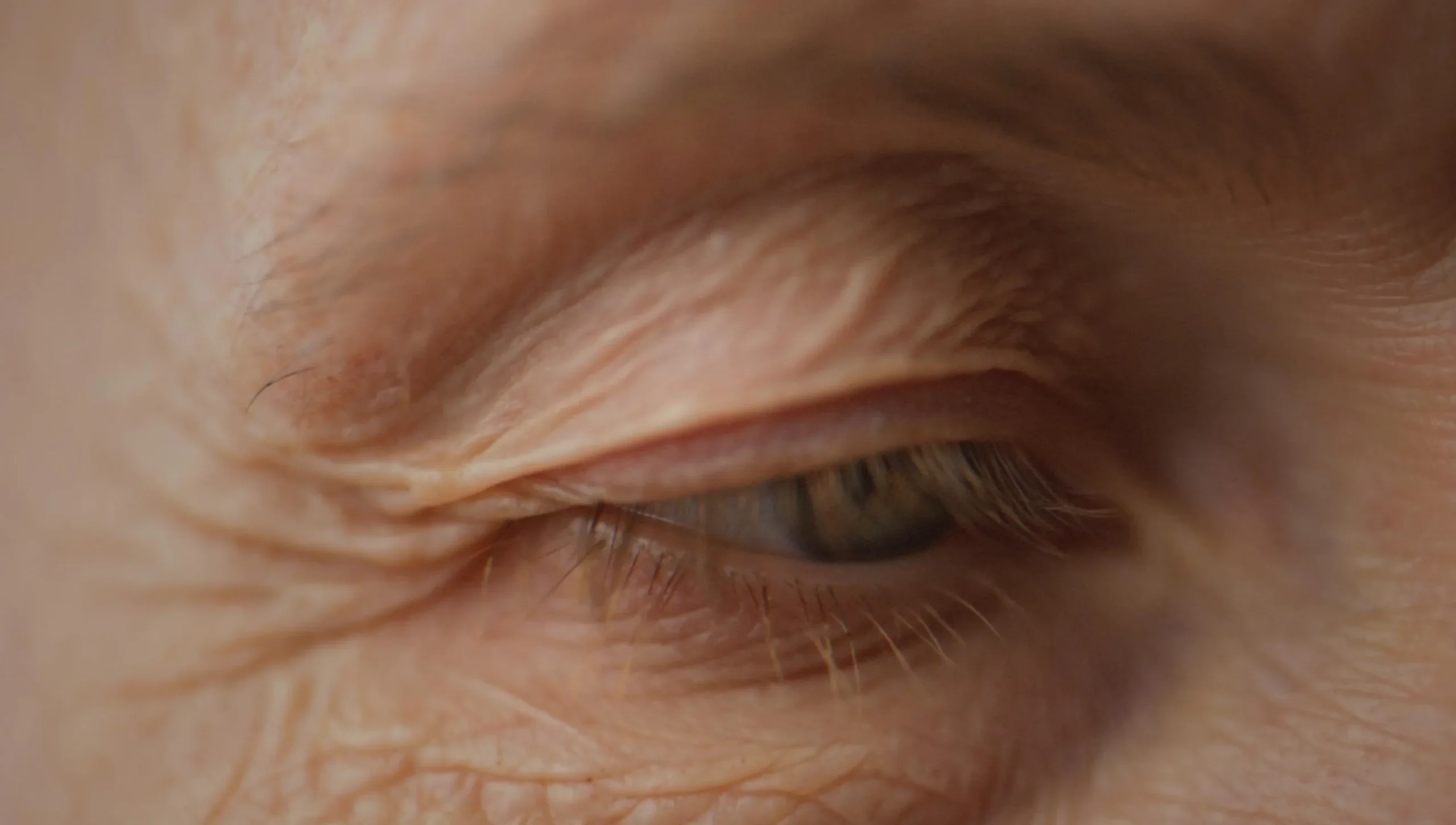 Laser Eyelid Tightening