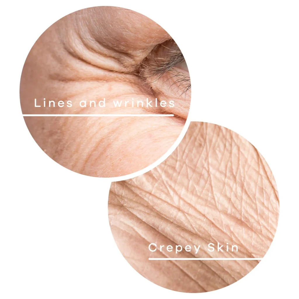 eyelid-treated - Anue
