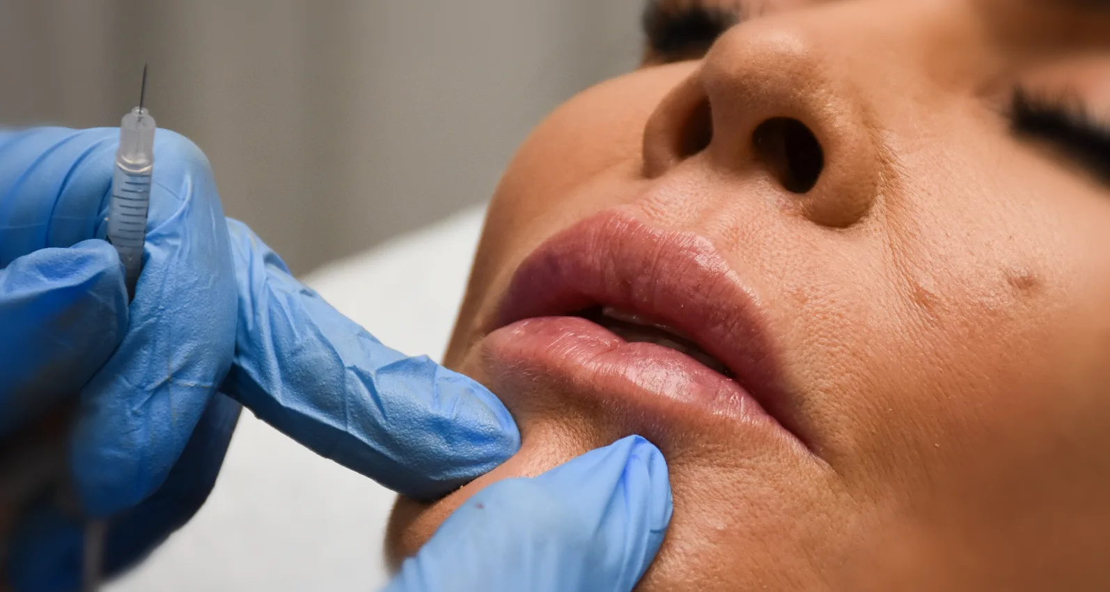 Dermal Filler
