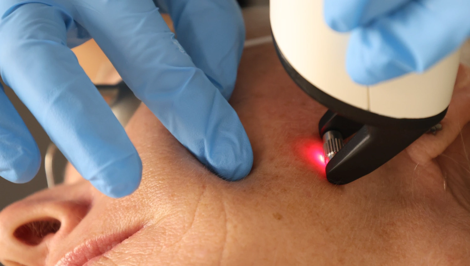 Fractional Laser