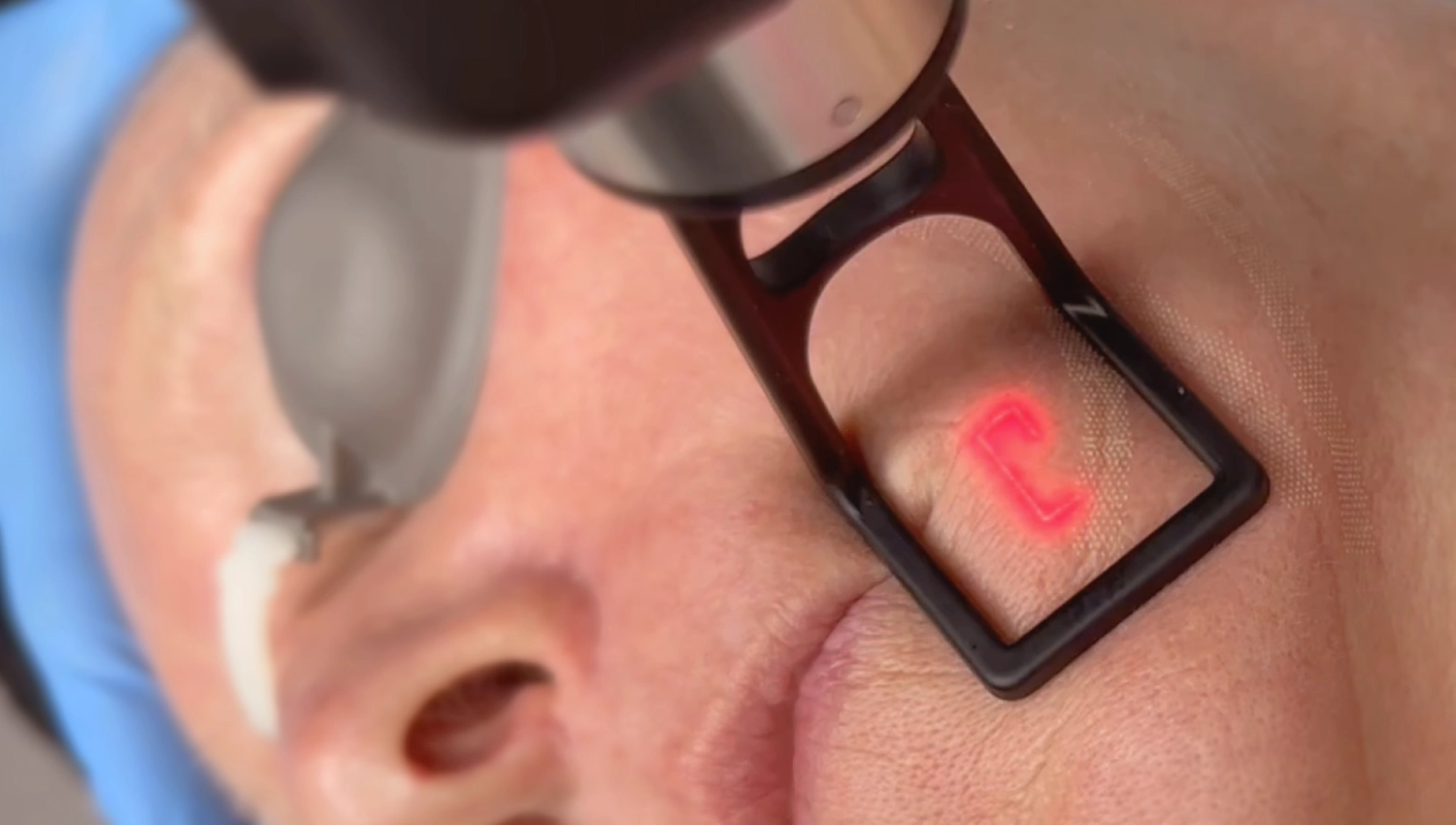Fractional CO2 Laser Treatment for the Face