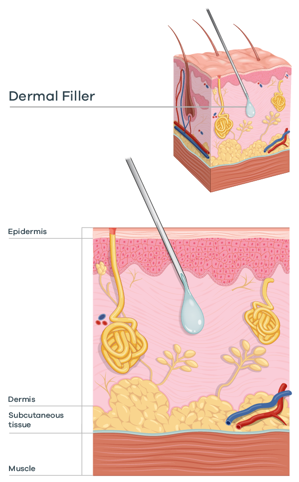 dermal filler diagram