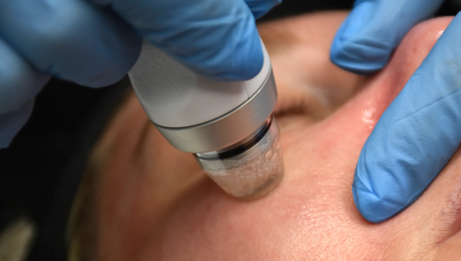 Glace Glass Skin Treatment