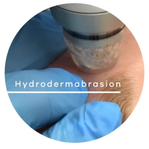 Close-up of a hydrodermabrasion treatment on the skin, with a clinician wearing blue gloves holding a handheld device.