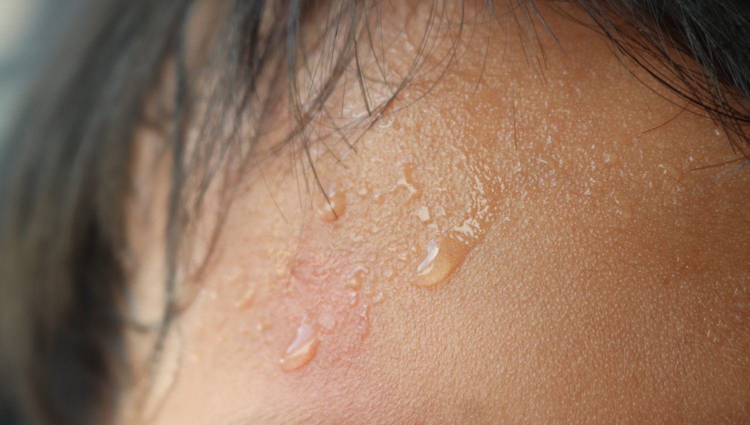 Hyperhidrosis treatment