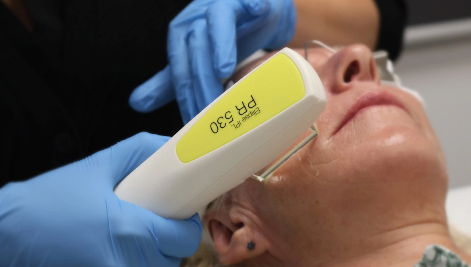 Intense Pulsed Light therapy