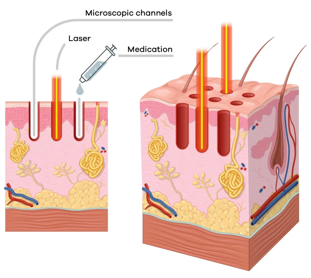 Repigmentation treatment