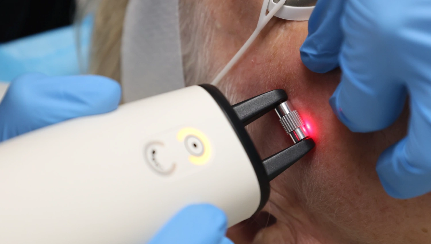 Skin Rejuvenation