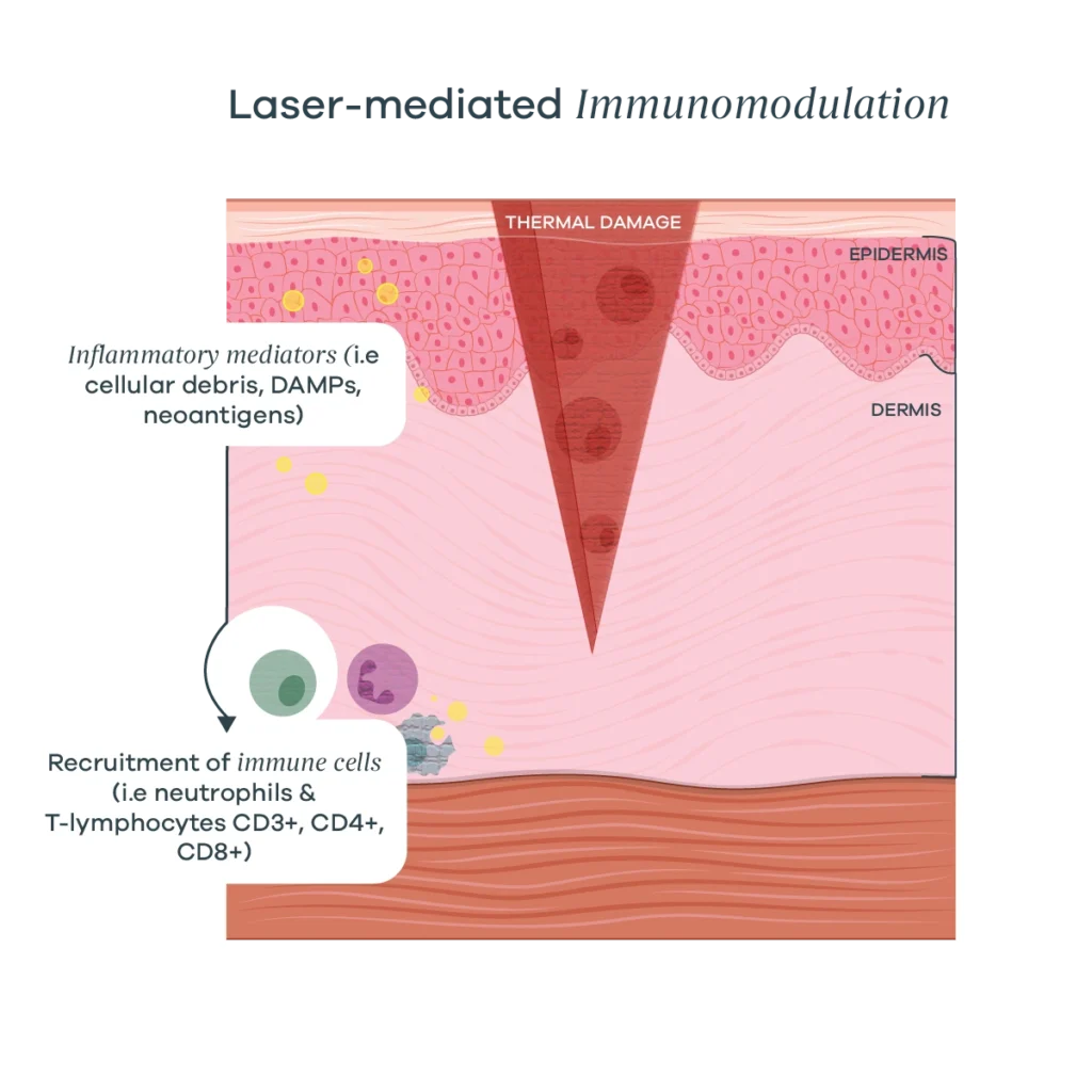 Cross-section of skin illustrating laser-induced immunomodulation, with inflammatory mediators released and immune cell recruitment shown in the dermis and epidermis