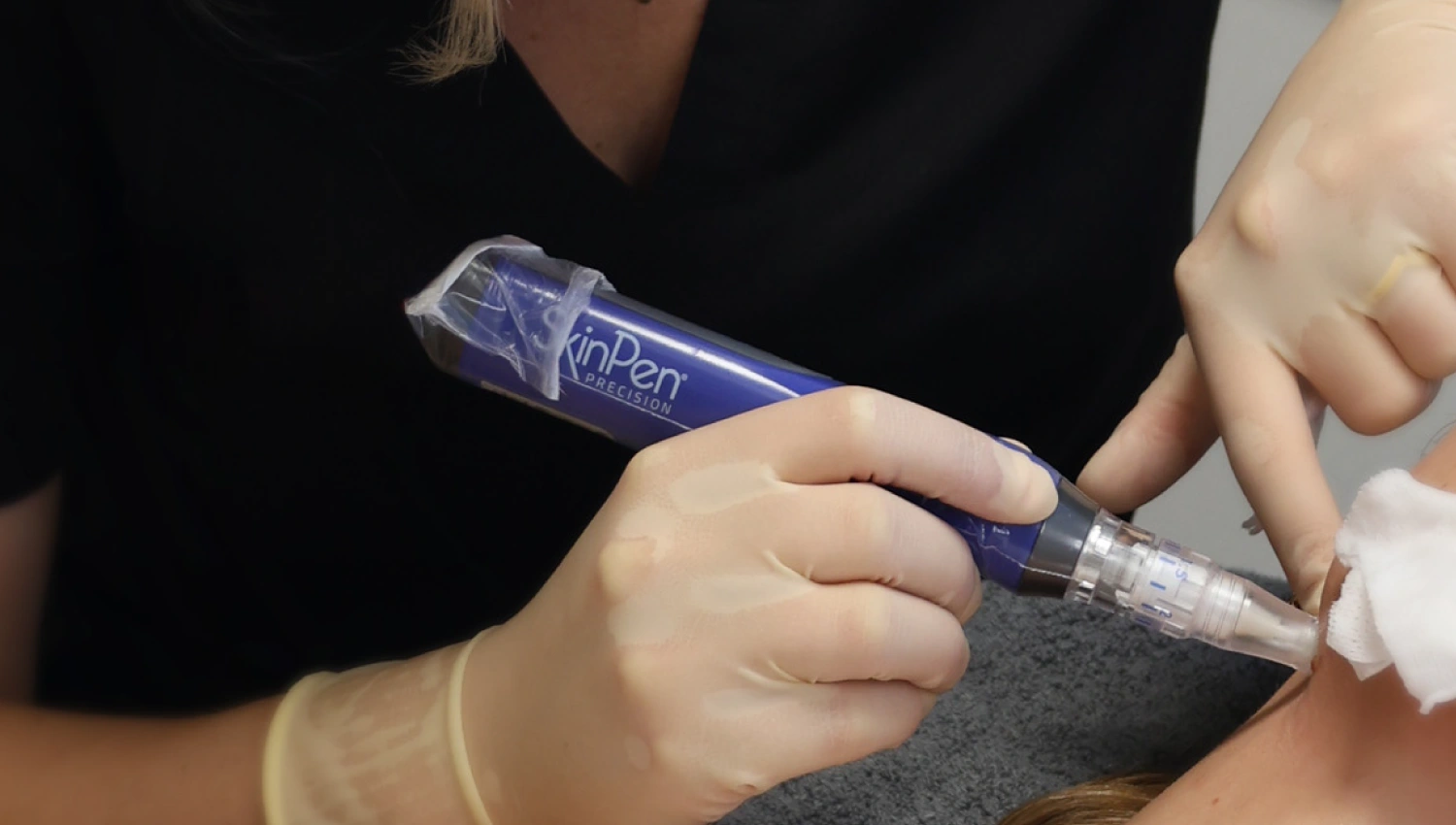 Microneedling