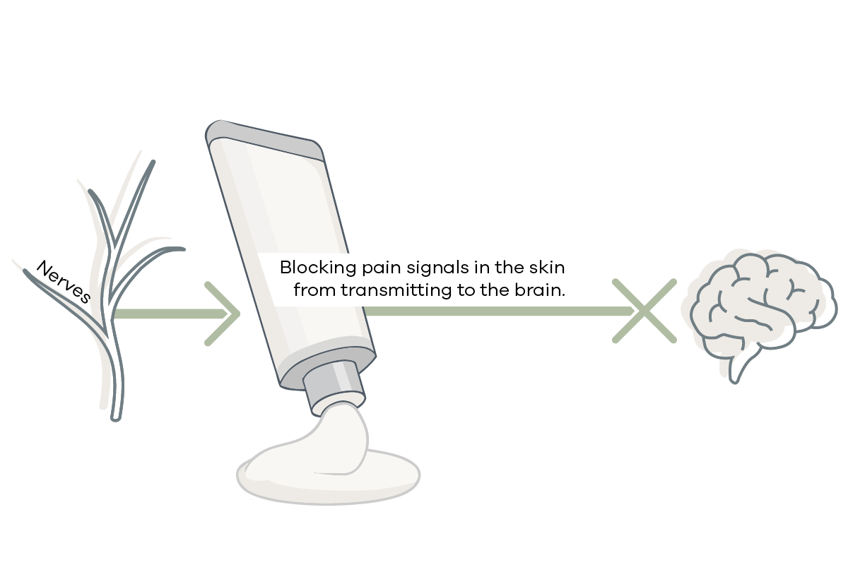 Diagram showing a device blocking pain signals from skin to the brain at the nerve path.