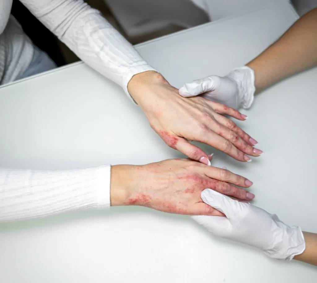Skin health Two gloved hands holding a person's wrist over a white surface, suggesting a medical check or first aid.