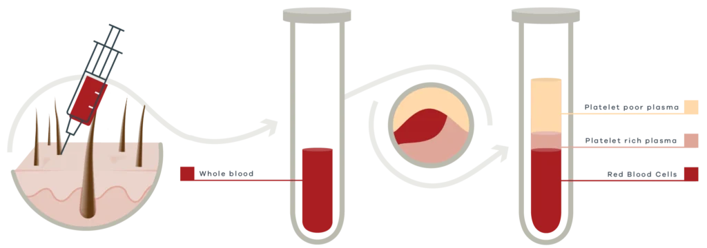 How PRP treatment: Platelet rich plasma works