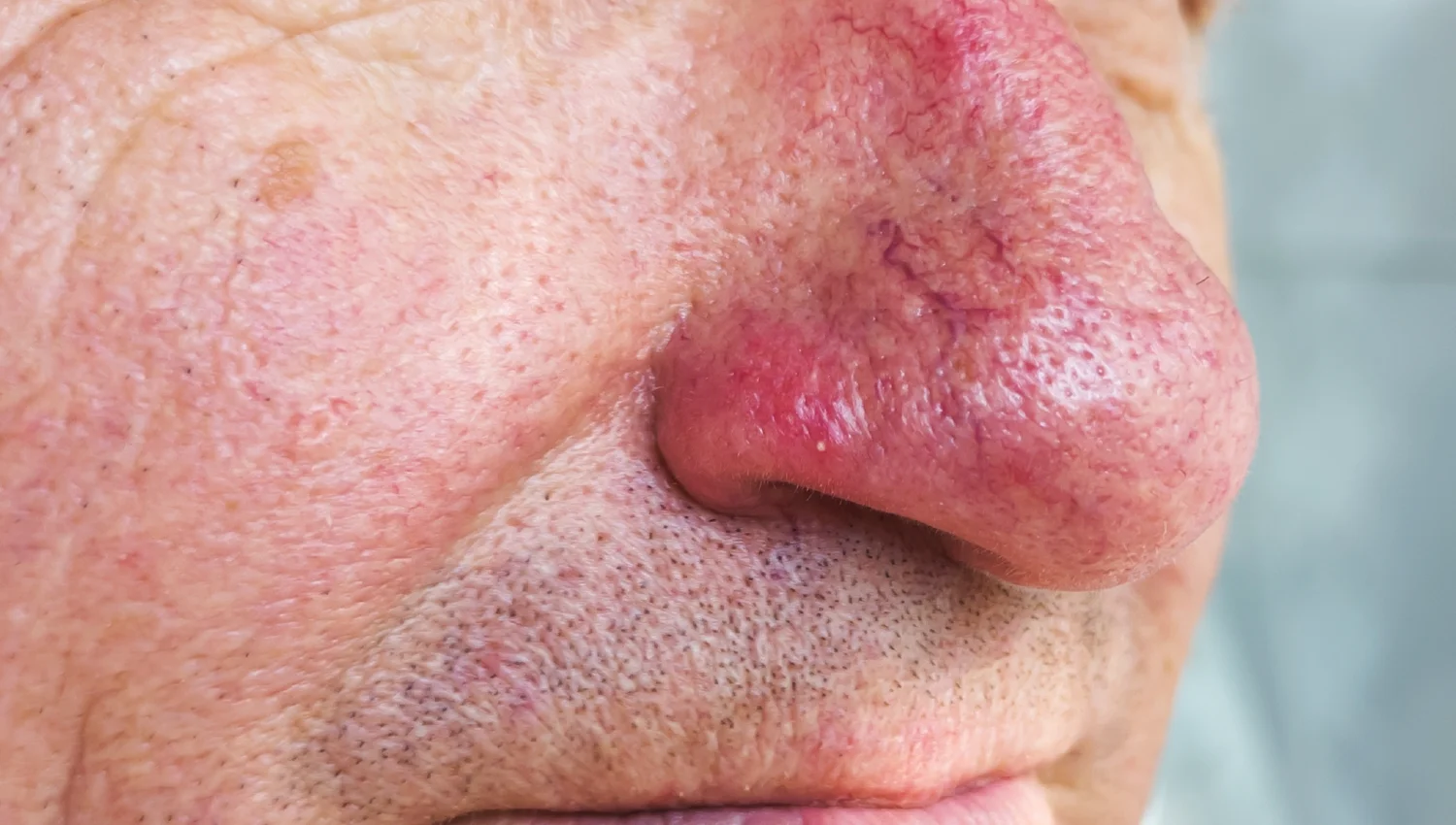 rhinophyma treatment