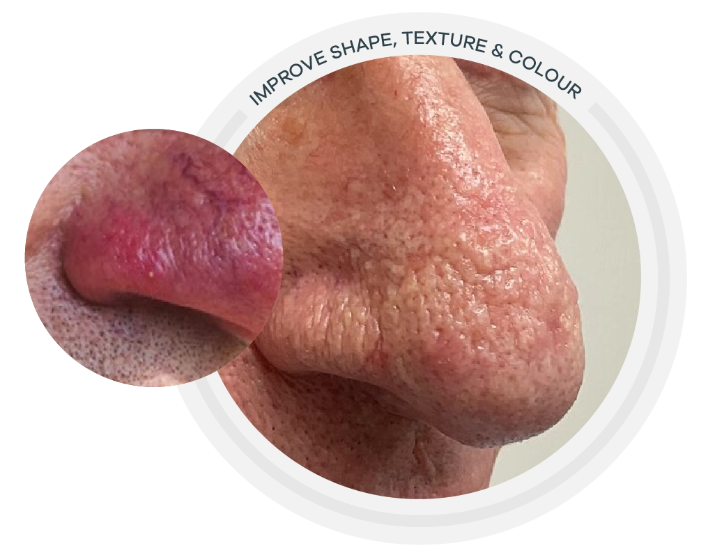 rhinophyma-symptom - Anue rhinophyma nose, redness, bubble texture