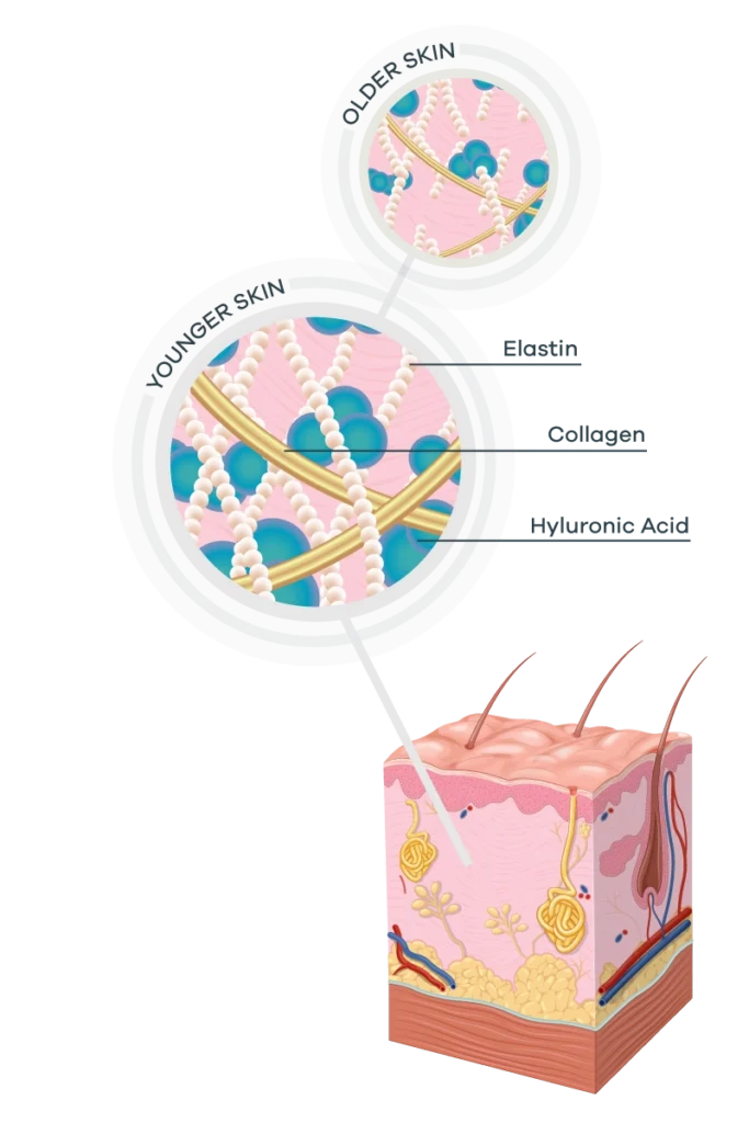 Cross-section of younger vs older skin showing elastin, collagen, and hyaluronic acid in zoomed-in circles to explain aging effects.